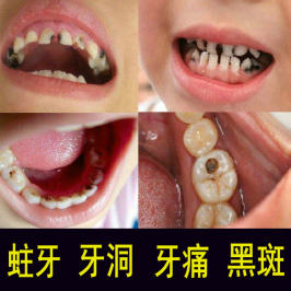 苏御园健齿散成人儿童牙粉非防蛀牙修复牙洞黑斑牙疼非牙痛含氟